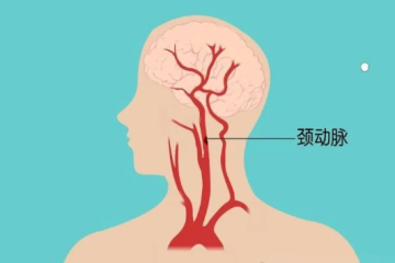 【特色诊疗】斑块稳定性的“鉴定官”——颈动脉超声造影